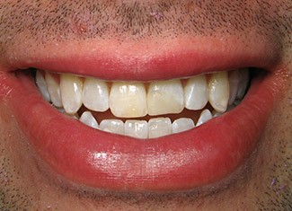 Patient with yellow top teeth