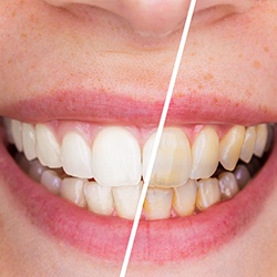 Teeth half before and half after teeth whitening