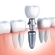 Model of implant, abutment, and crown in gumline