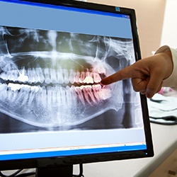 Hand poinging to dental x-rays on computer screen