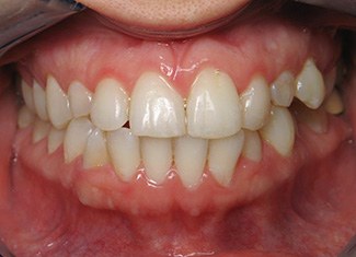 Smile with inflamed gums