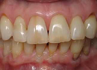 Yellowed and decayed teeth