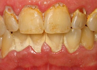 Severely yellowed and decay front teeth