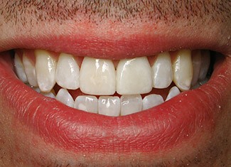 Closeup of bright white smile after treatment