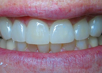 Repaired front tooth and seamless alignment