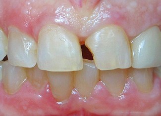 Damaged front tooth leaving gap