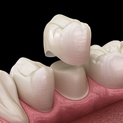 3D mock up of a dental crown capping a tooth
