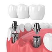 Diagram highlighting an implant bridge and its components