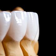 Dental restorations resting on a model