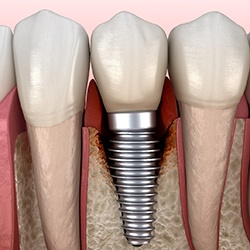 Render of failed dental implant in Buckhead, GA