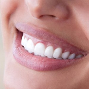Closeup of woman with veneers smiling
